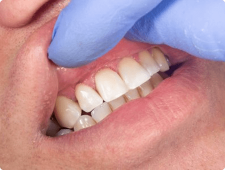 Aesthetic & Restorative Periodontal Dentistry | West Calgary Periodontics