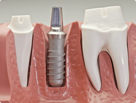 Dental Implants | West Calgary Periodontics