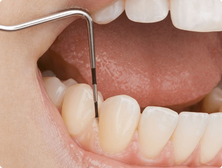 Periodontal Disease | West Calgary Periodontics