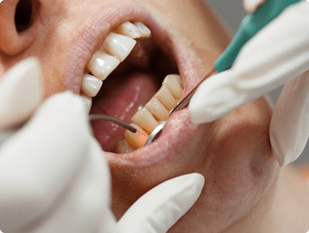 Soft and Hard Tissue Regeneration | West Calgary Periodontics