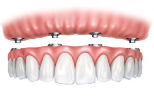 All On Four Hybrid Bridge | West Calgary Periodontics