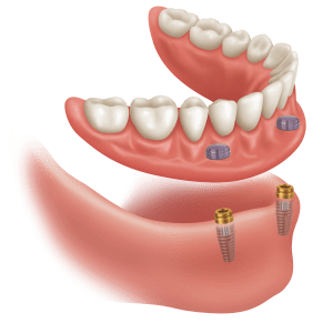 Full Arch Upper Replacement with Dentures | West Calgary Periodontics