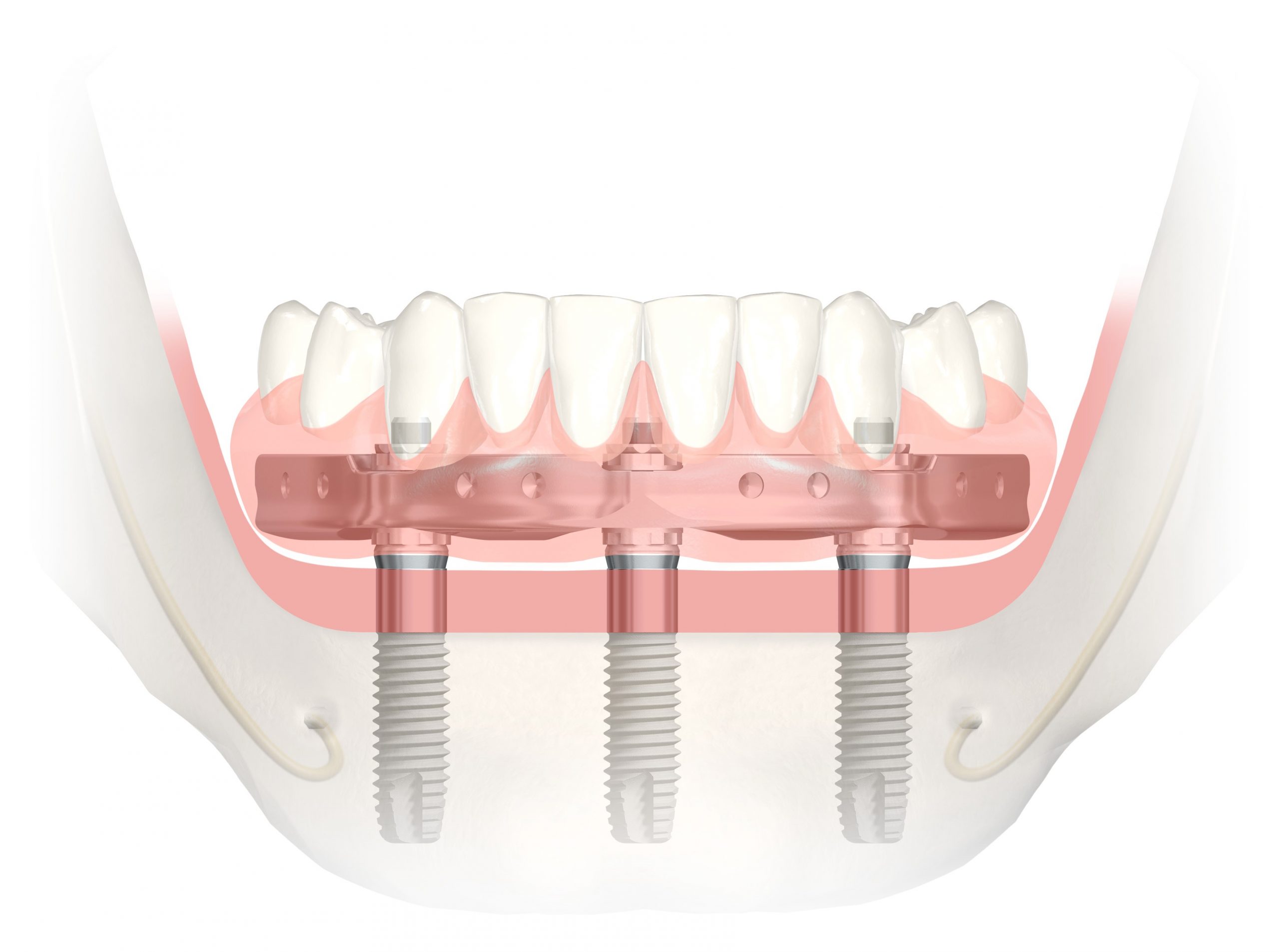 Full Arch Upper Replacement Trefoil | West Calgary Periodontics