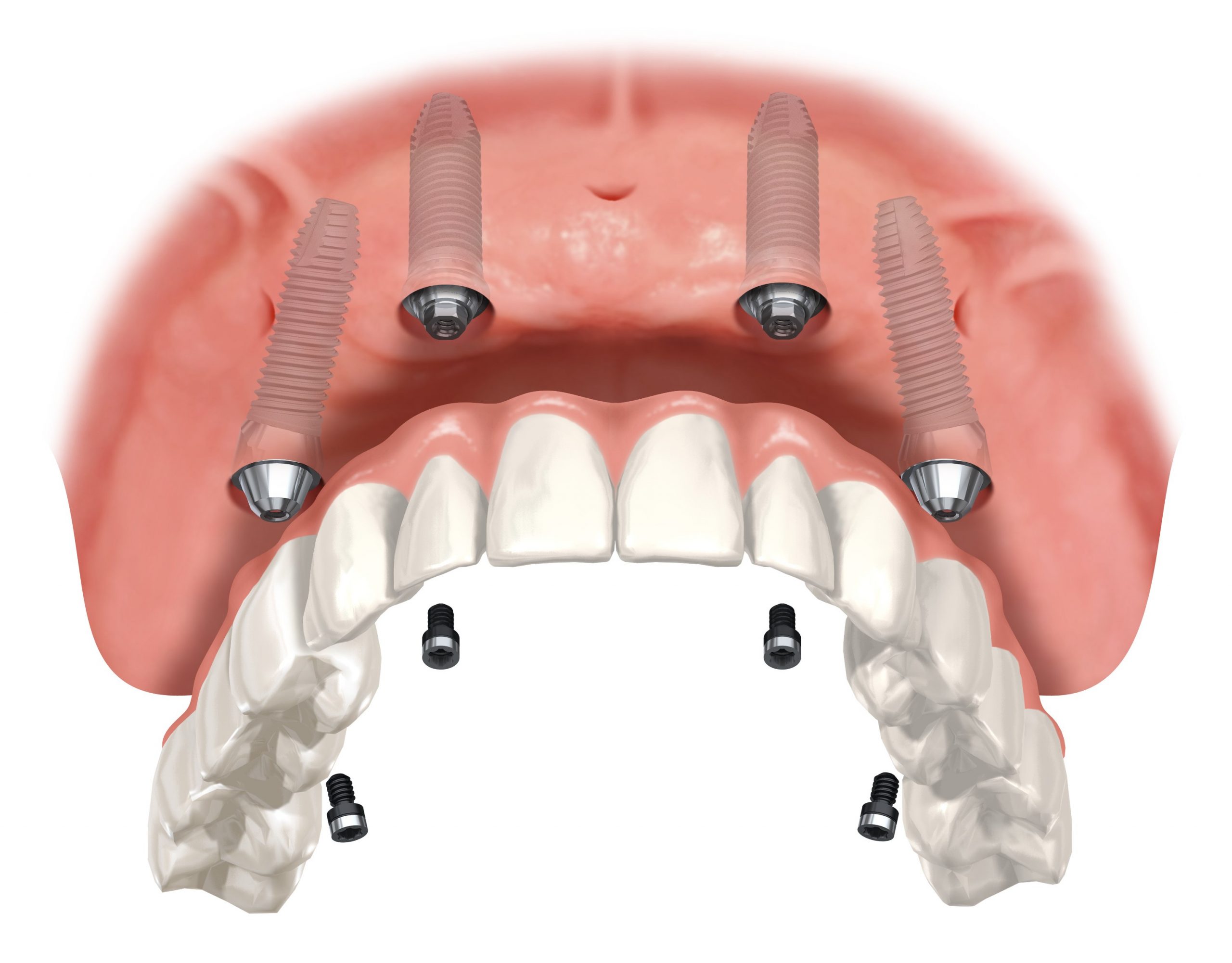Full Arch Upper Replacement | West Calgary Periodontics