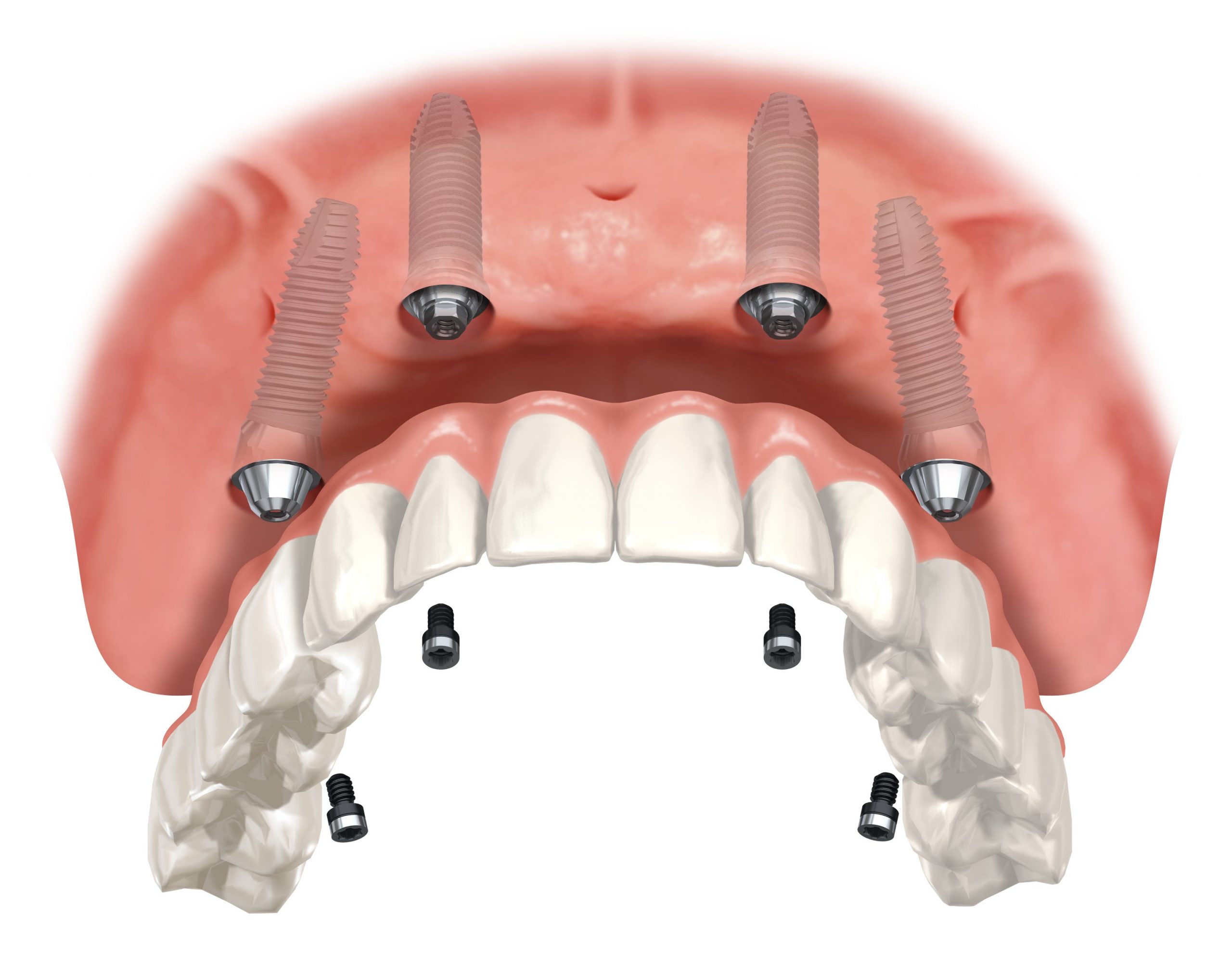 Full Arch Upper Replacement | West Calgary Periodontics