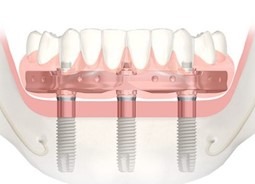 Trefoil Full Arch Upper Replacement | West Calgary Periodontics