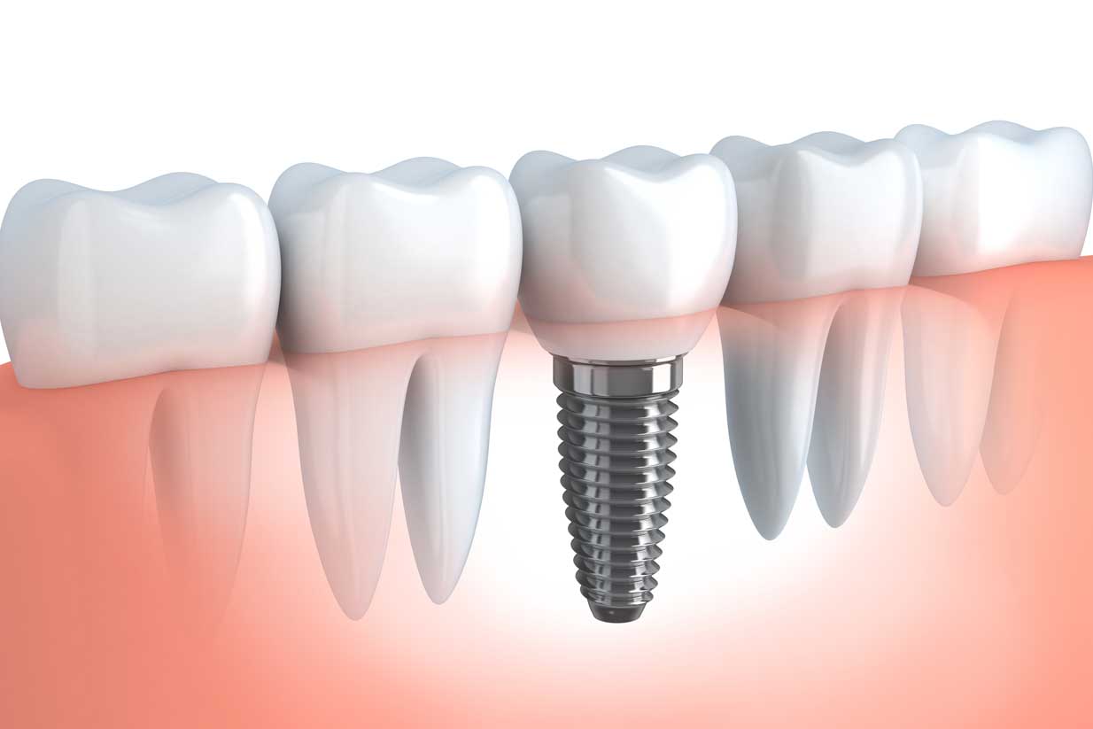 Dental Implants | West Calgary Periodontics