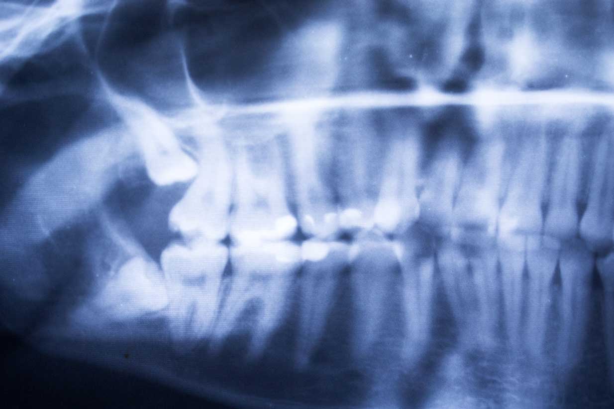 Wisdom Teeth Extraction | West Calgary Periodontics